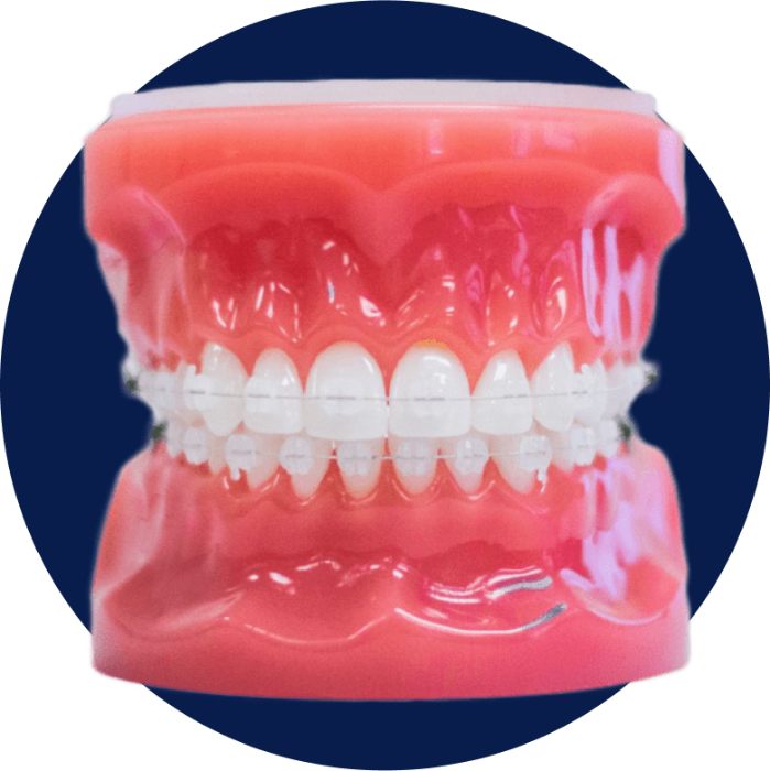 Clear Braces at Kwong Orthodontics