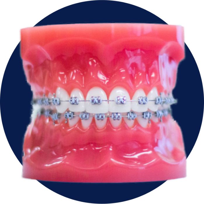 Metal Braces at Kwong Orthodontics